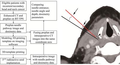 The Accuracy of Individualized 3D-Printing Template-Assisted I125 Radioactive Seed Implantation for Recurrent/Metastatic Head and Neck Cancer